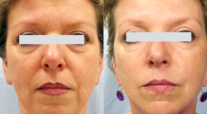 Before and After of a middle-aged woman who received Tixel treatments. The after picture shows a noticeable improvement in wrinkles.