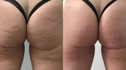 Before and After Sculpt treatments demonstrating improvement in cellulite on the buttocks.