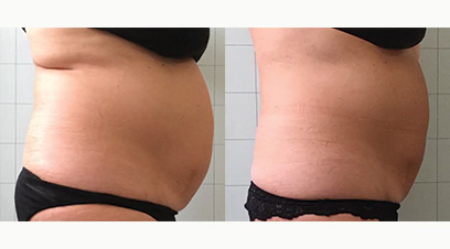 Sculpt before and after images showing the profile of the stomach, which is significantly smaller and flatter in the after image.