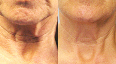 A before and after photo demonstrating Tixel’s effect on the neck. The skin in the after picture is visibly tighter and smoother.