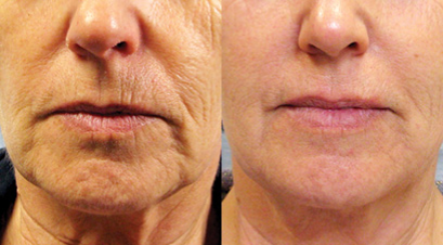 Before and after Tixel treatments on the lower face. The after picture shows marked improvement in the wrinkles visible in the before picture.